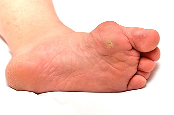 papilloma in feet