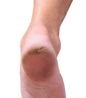 Causes of clearance cracks in feet