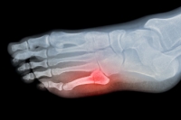Recognizing Common Symptoms of a Broken Foot