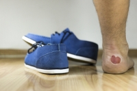 Possible Causes of Blisters on the Feet