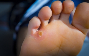 Is It a Wart or a Corn?