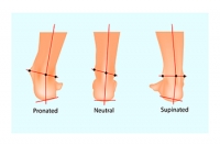 Overpronation and Risk of Injuries