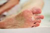 When Plantar Warts Are Painful