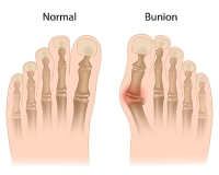 Bunions May Affect Runners