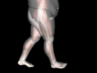 Foot Conditions May Develop as a Result of Being Obese