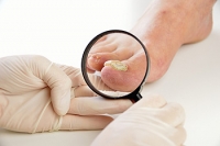 Facts About Toenail Fungus